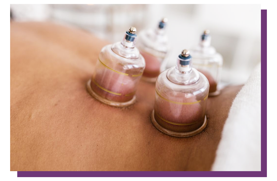 cupping-therapy-2