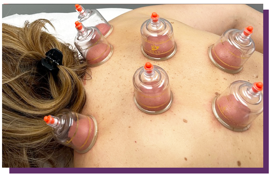 cupping-therapy-3