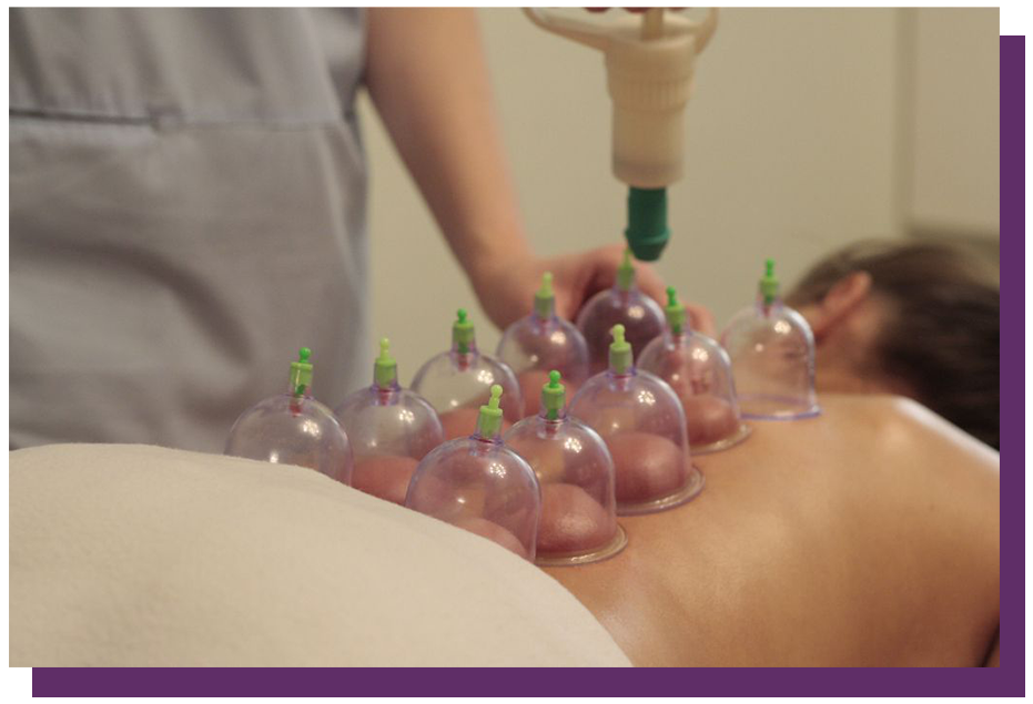 cupping-therapy